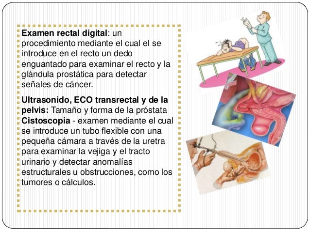 Hiperplasia prostática benigna Hiperplasia prostática benigna