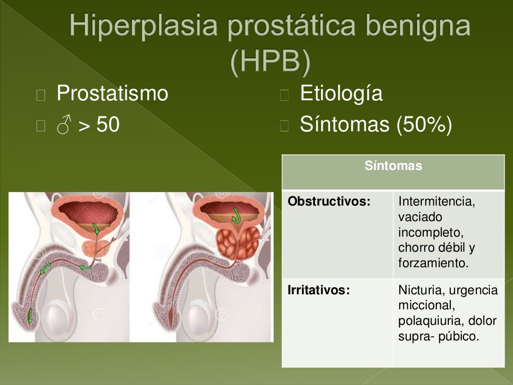 Hiperplasia prostática benigna, cáncer de próstata y Urolitiasis Hiperplasia prostática benigna, cáncer de próstata y Urolitiasis