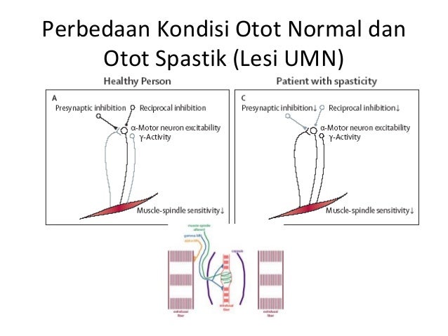 Perbedaan Paralisis Spastik Dan Flaksid Pada Cacing Perbedaan Paralisis Spastik Dan Flaksid Pada Cacing