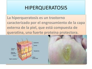 HIPERQUERATOSIS
La hiperqueratosis es un trastorno
caracterizado por el engrosamiento de la capa
externa de la piel, que está compuesta de
queratina, una fuerte proteína protectora.
 
