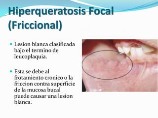 Hiperqueratosis Focal
(Friccional)
 Lesion blanca clasificada
  bajo el termino de
  leucoplaquia.

 Esta se debe al
  frotamiento cronico o la
  friccion contra superficie
  de la mucosa bucal
  puede causar una lesion
  blanca.
 