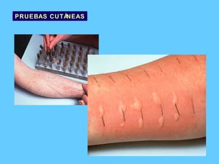 PRUEBAS CUTÁNEAS 