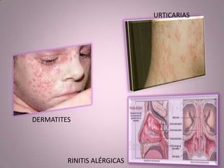 DERMATITES
URTICARIAS
RINITIS ALÉRGICAS
 