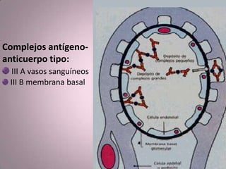 Complejos antígeno-
anticuerpo tipo:
III A vasos sanguíneos
III B membrana basal
 