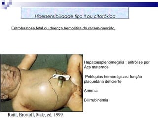 Hepatoesplenomegalia : eritrólise por
Acs maternos
Petéquias hemorrágicas: função
plaquetária deficiente
Anemia
Bilirrubinemia
Hipersensibilidade tipo II ou citotóxica
Eritrobastose fetal ou doença hemolítica do recém-nascido.
 