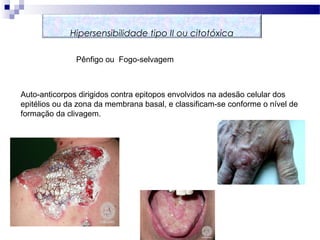 Hipersensibilidade tipo II ou citotóxica
Pênfigo ou Fogo-selvagem
Auto-anticorpos dirigidos contra epitopos envolvidos na adesão celular dos
epitélios ou da zona da membrana basal, e classificam-se conforme o nível de
formação da clivagem.
 