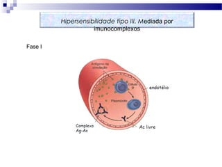 Iunidade Mediada por Imunocomplexos
Fase I
Hipersensibilidade tipo III. Mediada por
imunocomplexos
 
