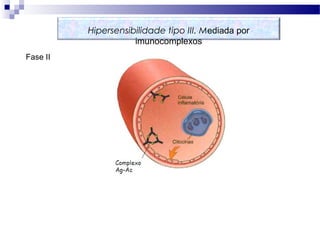 Fase II
Hipersensibilidade tipo III. Mediada por
imunocomplexos
 