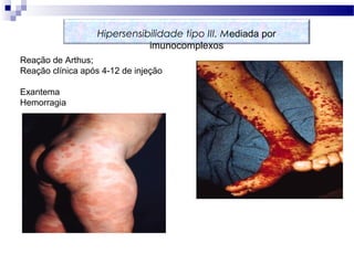 Imnidafde Mediadapor Imunocomplexos
Reação de Arthus;
Reação clínica após 4-12 de injeção
Exantema
Hemorragia
Hipersensibilidade tipo III. Mediada por
imunocomplexos
 