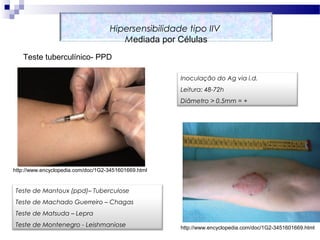 Hipersensibilidade tipo IIV
Mediada por Células
http://www.encyclopedia.com/doc/1G2-3451601669.html
http://www.encyclopedia.com/doc/1G2-3451601669.html
Teste tuberculínico- PPD
Inoculação do Ag via i.d.
Leitura: 48-72h
Diâmetro > 0.5mm = +
Teste de Mantoux (ppd)– Tuberculose
Teste de Machado Guerreiro – Chagas
Teste de Matsuda – Lepra
Teste de Montenegro - Leishmaniose
 