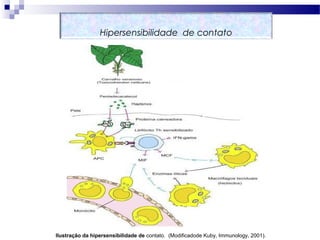 Ilustração da hipersensibilidade de contato. (Modificadode Kuby, Immunology, 2001).
Hipersensibilidade de contato
 