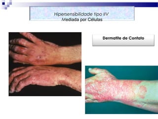 Hipersensibilidade tipo IIV
Mediada por Células
Dermatite de Contato
 