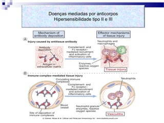 Doenças mediadas por anticorpos
Hipersensibilidade tipo II e III
 