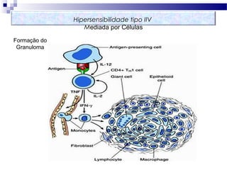 Hipersensibilidade tipo IIV
Mediada por Células
Formação do
Granuloma
 
