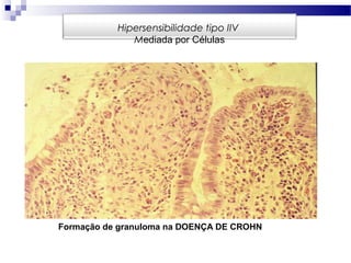 Formação de granuloma na DOENÇA DE CROHN
Hipersensibilidade tipo IIV
Mediada por Células
 