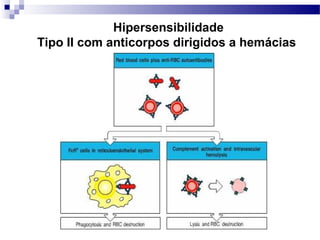 Hipersensibilidade
Tipo II com anticorpos dirigidos a hemácias
 