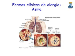 Formas clínicas de alergia:
Asma

 