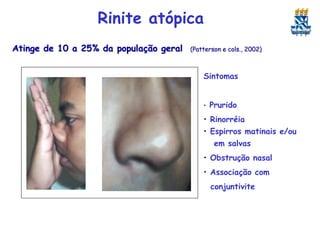 Rinite atópica
Atinge de 10 a 25% da população geral

(Patterson e cols., 2002)

Sintomas
•

Prurido

• Rinorréia
• Espirros matinais e/ou
em salvas

• Obstrução nasal
• Associação com
conjuntivite

 