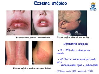 Eczema atópico

Eczema atópico, crinaça 4 anos,em lábios

Eczema atópico, crinaça 1 ano, em face

Dermatite atópica
- 5 a 20% das crianças no
mundo
- 60 % continuam apresentando
esta
enfermidade após a puberdade
Eczema atópico, adolescente , em dobras

(Williams e cols.,1999.; Wuthrich, 1999)

 