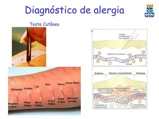 Diagnóstico de alergia
Teste Cutâneo

 