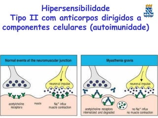 Hipersensibilidade
Tipo II com anticorpos dirigidos a
componentes celulares (autoimunidade)

 