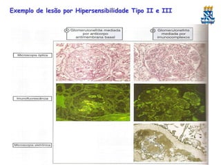 Exemplo de lesão por Hipersensibilidade Tipo II e III

 