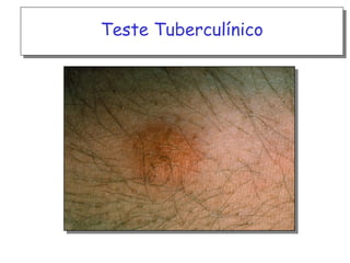 Teste Tuberculínico

 