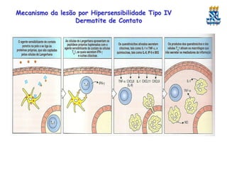 Mecanismo da lesão por Hipersensibilidade Tipo IV
Dermatite de Contato

 