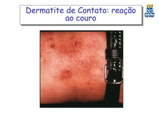 Dermatite de Contato: reação
ao couro

 