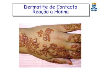 Dermatite de Contacto
Reação a Henna

 