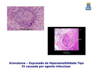 Granuloma – Expressão de Hipersensibilidade Tipo
IV causada por agente infeccioso

 