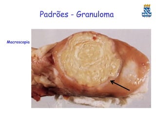 Padrões - Granuloma

Macroscopia

 