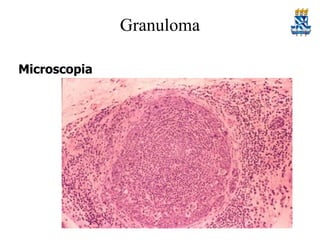Granuloma
Microscopia

 