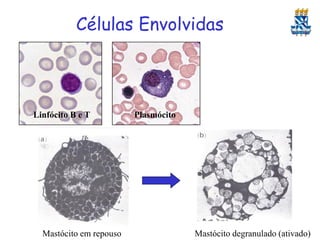 Células Envolvidas

Linfócito B e T

Mastócito em repouso

Plasmócito

Mastócito degranulado (ativado)

 