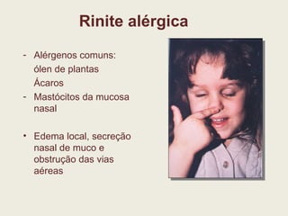 Rinite alérgica Alérgenos comuns: ólen de plantas Ácaros Mastócitos da mucosa nasal Edema local, secreção nasal de muco e obstrução das vias aéreas 