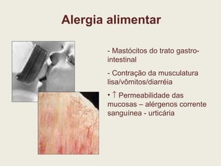 Alergia alimentar - Mastócitos do trato gastro-intestinal - Contração da musculatura lisa/vômitos/diarréia    Permeabilidade das mucosas – alérgenos corrente sanguínea - urticária 