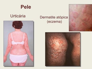 Pele Urticária Dermatite atópica (eczema) 