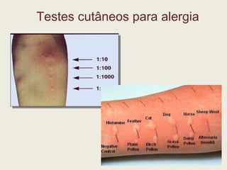 Testes cutâneos para alergia 