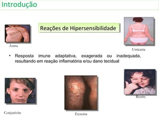 • Resposta imune adaptativa, exagerada ou inadequada,
resultando em reação inflamatória e/ou dano tecidual
Reações de HipersensibilidadeReações de Hipersensibilidade
Asma
Urticaria
Renite
EczemaConjutivite
Introdução
 
