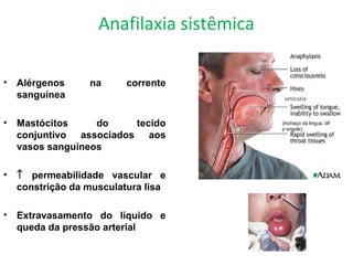 Anafilaxia sistêmica
• Alérgenos na corrente
sanguínea
• Mastócitos do tecido
conjuntivo associados aos
vasos sanguíneos
• ↑ permeabilidade vascular e
constrição da musculatura lisa
• Extravasamento do líquido e
queda da pressão arterial
urticaria
(Inchaço da lingua, dif
p engolir)
 