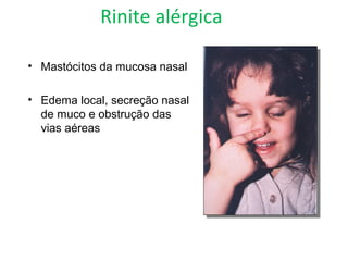 Rinite alérgica
• Mastócitos da mucosa nasal
• Edema local, secreção nasal
de muco e obstrução das
vias aéreas
 