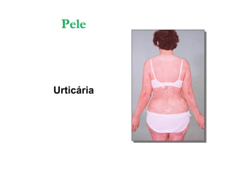 Pele
Urticária
 