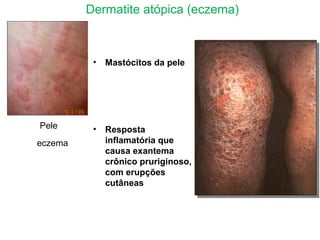 Pele
eczema
Dermatite atópica (eczema)
• Mastócitos da pele
• Resposta
inflamatória que
causa exantema
crônico pruriginoso,
com erupções
cutâneas
 