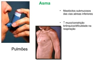 Pulmões
Asma
• Mastócitos submucosos
das vias aéreas inferiores
• ↑ muco/constrição
brônquica/dificuldade na
respiração
 