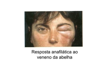 Resposta anafilática ao
veneno da abelha
 