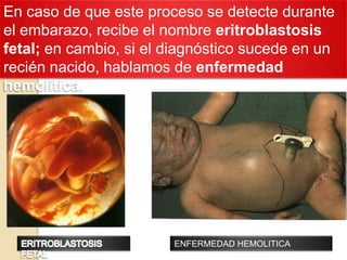 ERITROBLASTOSIS FETALENFERMEDAD FETONEONATAL PROVOCADA POR INCOMPATIBILIDAD SANGUINEA FETO/MATERNA.