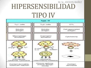 HIPERSENSIBILIDAD
TIPO IV
M. Sc. JOCELYN IBAÑEZ
 