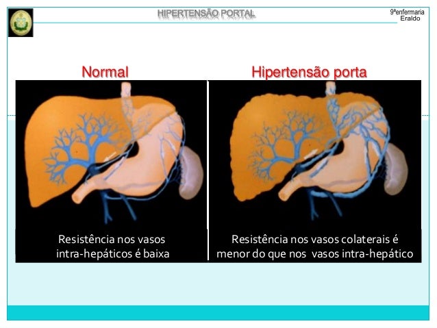 Hipertensão portal