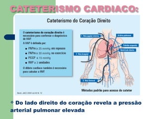  Do lado direito do coração revela a pressão
arterial pulmonar elevada
 