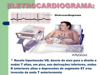  Revela hipertensão VD, desvio do eixo para a direita e
ondas T altas, em pico, nas derivações inferiores, ondas
R anteriores altas e depressões do segmento ST e/ou
inversão da onda T anteriormente
 